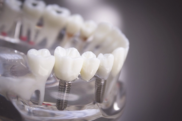 Implante Dentário